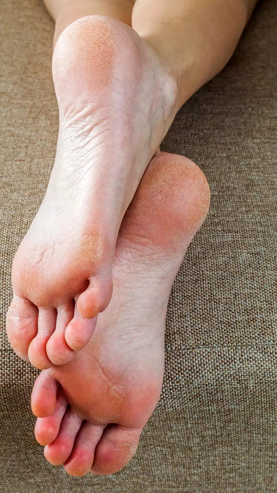 Cracked Heels Herbal Treatment, Prevention, Symptoms, Causes, Cured By