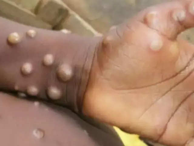 Monkeypox is a global public health emergency, WHO triggers highest alert