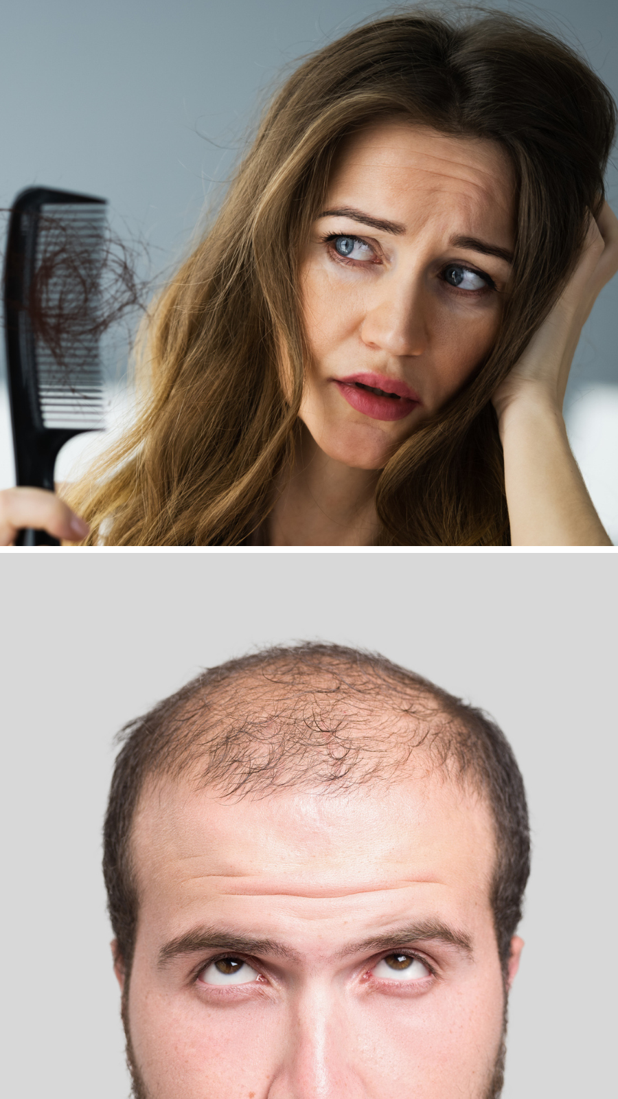 10 Most Common Types of Hair Loss