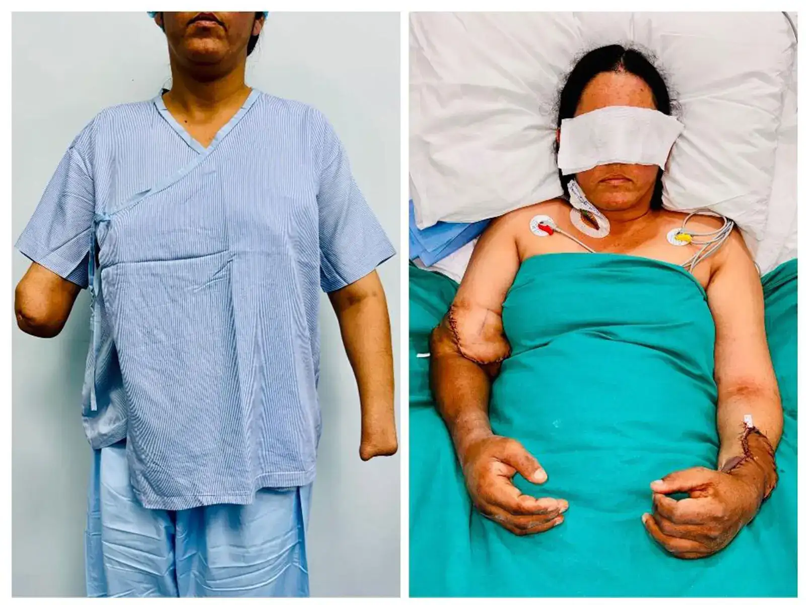 Mother of two gets new hands after accident, 12 hour transplant brings fresh hope