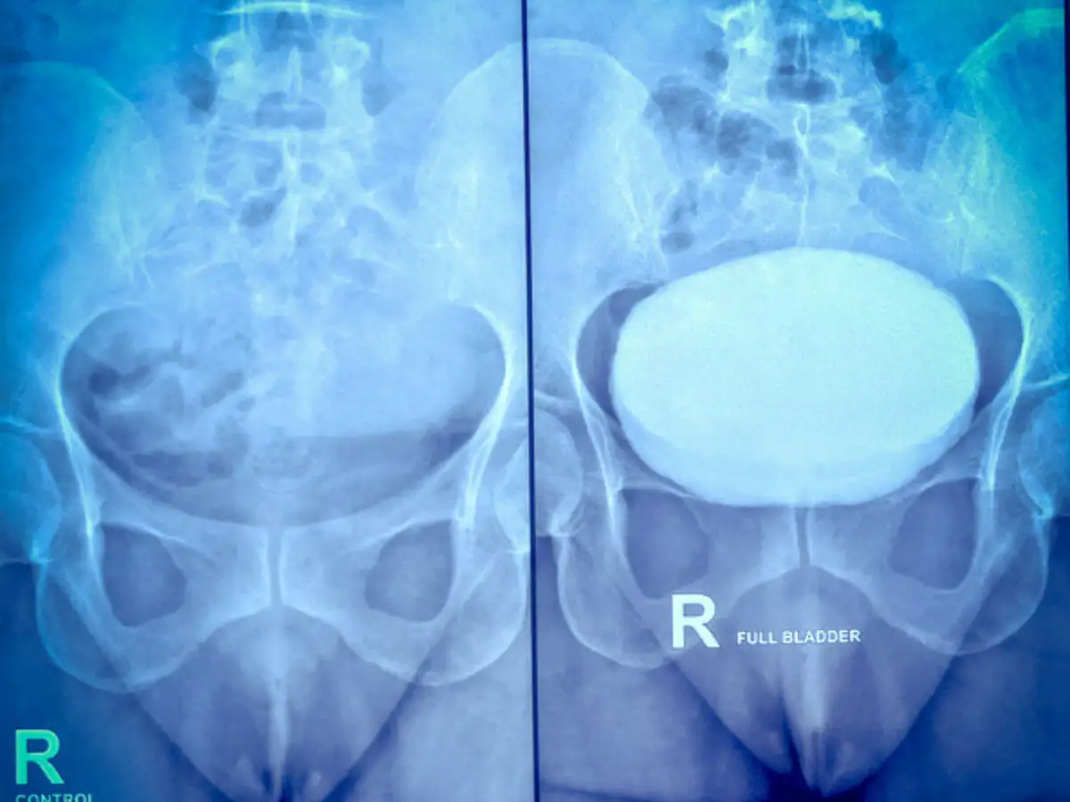 Covid is now hitting young Indians in a shocking new way, doctors say people in their 30s are suddenly needing hip replacements