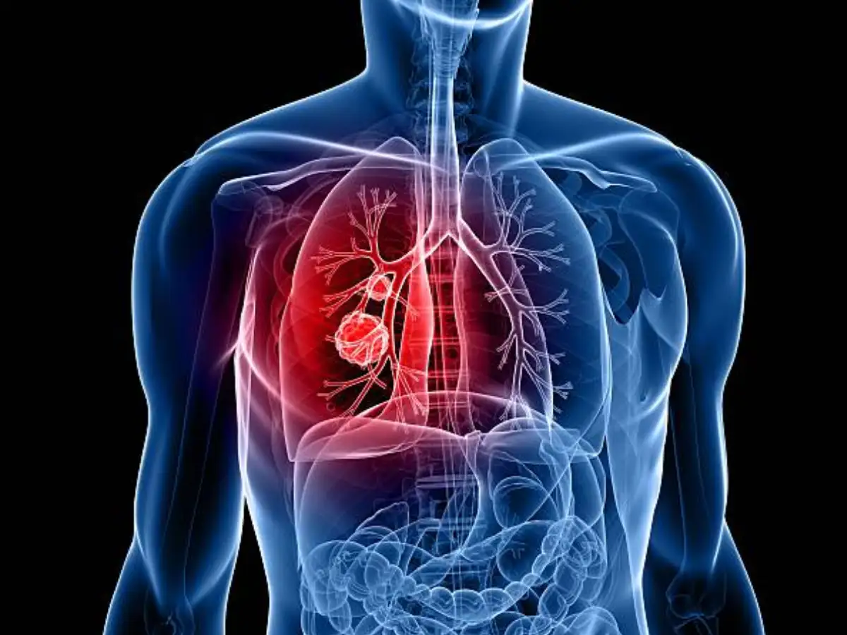 This blood test may reveal lung cancer risk long before symptoms