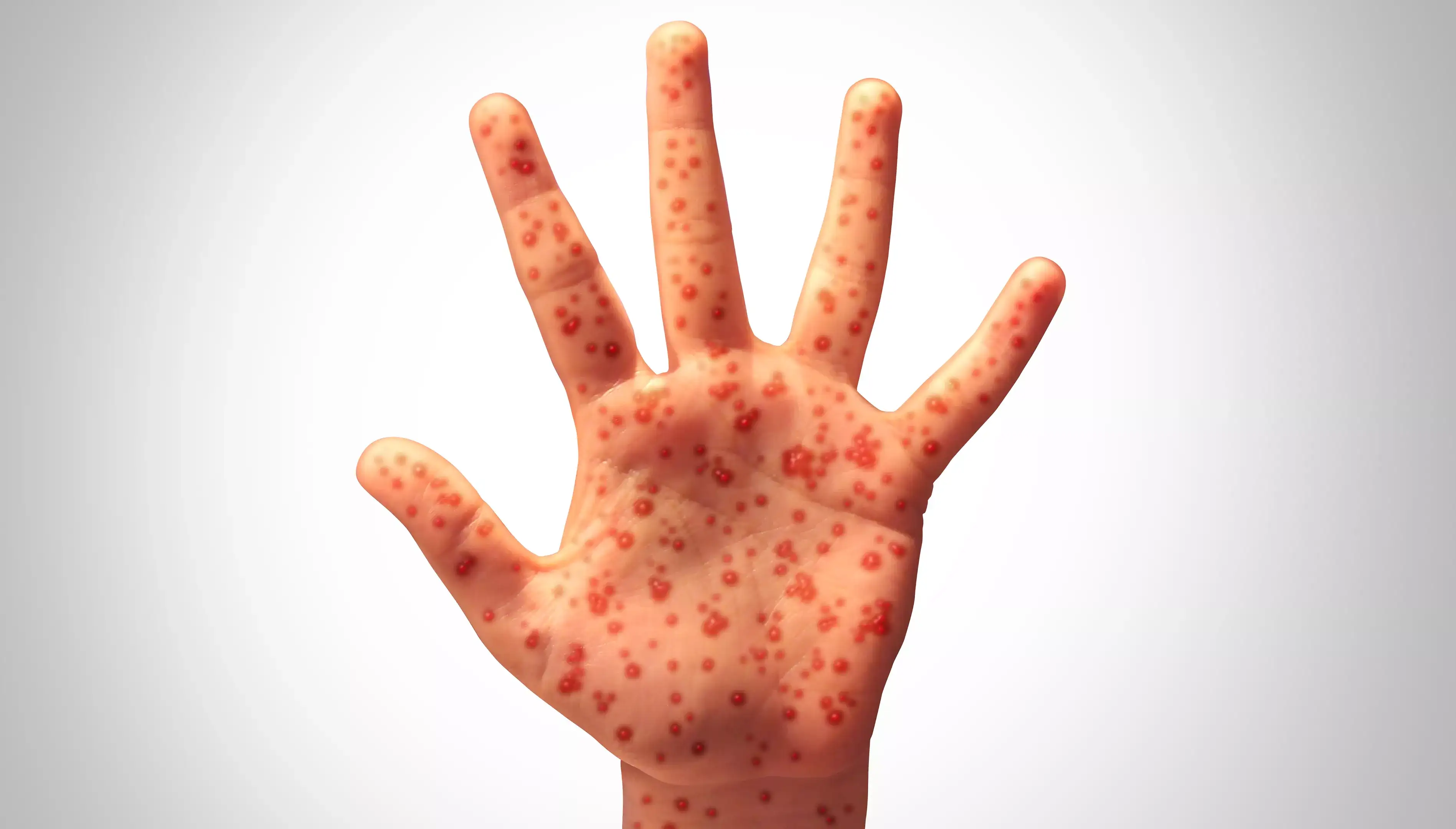 World's most contagious disease detected in California wastewater: Key signs of virus and symptoms you should watch