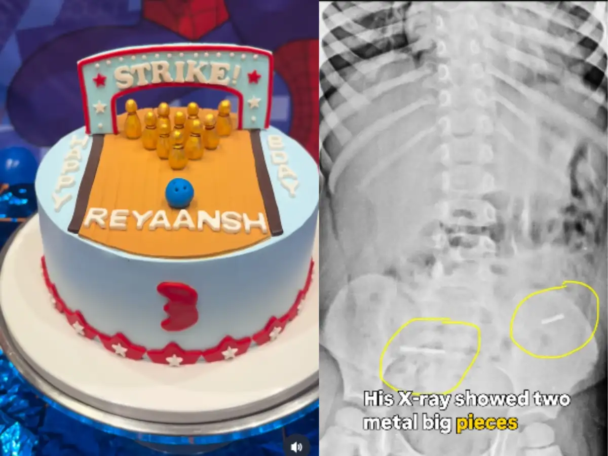 Birthday horror! 3-year-old swallows metal wires hidden in c