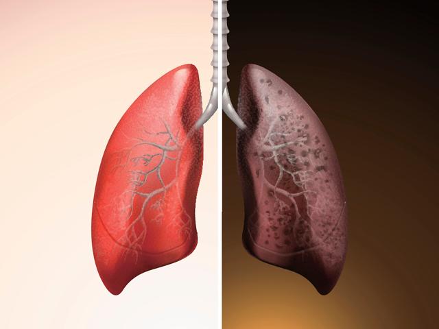 Lung Cancer Alert Visit A Doctor Right Away If You Have A Persistent Cough The Economic Times