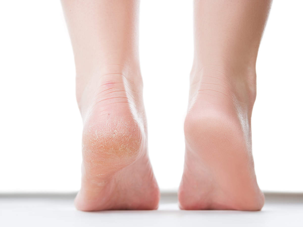 Why heel pain after running?