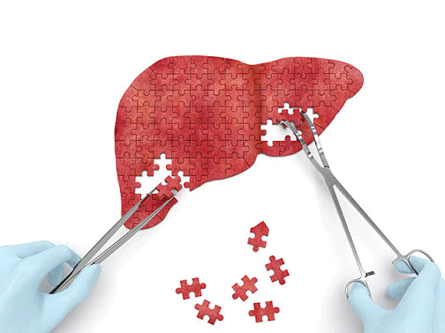 Non-alcoholic Fatty Liver Disease: Avoid high fat diet: It can lead to  life-threatening liver disease - The Economic Times