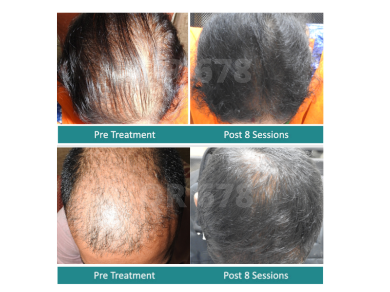 Best Hair Loss Treatment In Bangalore | Venkat Center