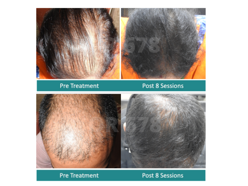 Best treatment store for hair fall