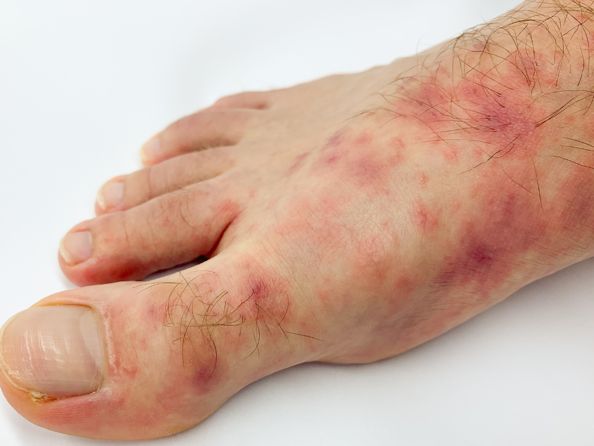 Foot Rash: Causes, Symptoms & Treatment