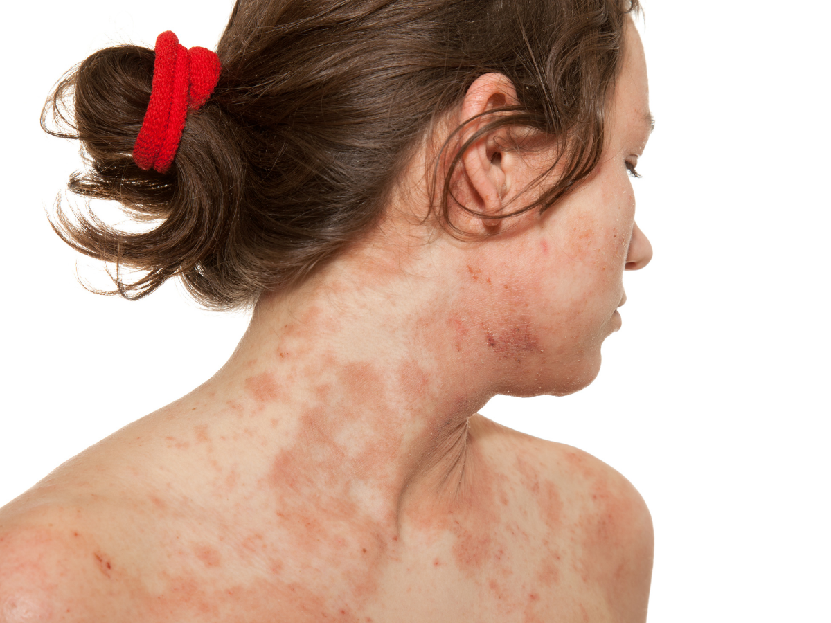 Covid Skin Rashes From purple toes to hives and eczema How to deal