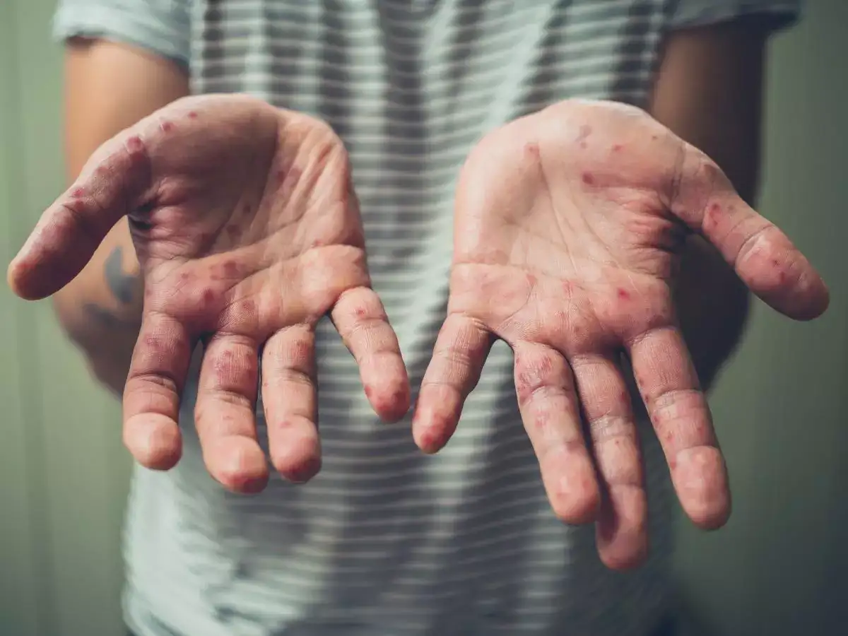 Monkeypox can cause anxiety & depression in patients, says new study ...