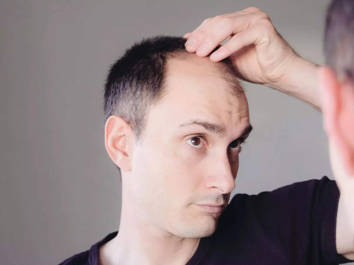 hair Loss: Male pattern baldness that won't go away? Blame your sugar  intake! - The Economic Times