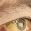 Jaundice