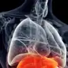 9 early warning signs of liver cancer that are easy to miss