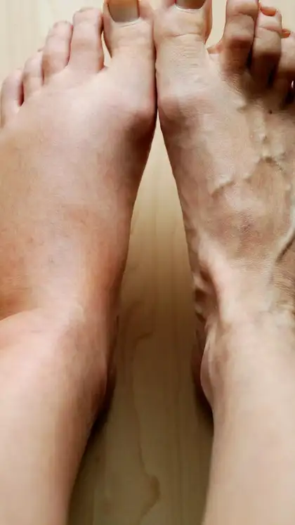 Swelling in feet and ankles