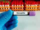 Sanofi healthcare receives CDSCO approval for Qftilia therapy for haemophilia patients in India