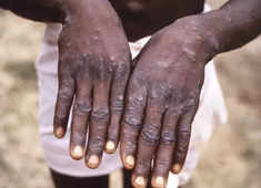 Monkeypox is not as severe as COVID, but its spread a matter of concern: NTAGI Chairman