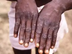 Covid vaccine doesn't cause monkeypox: Busting myths about this ailment