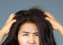 Dandruff problem? 9 home remedies to help