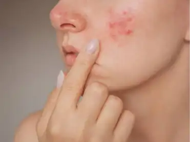 Tired of acne? Dermatologist lists six food items that can lead to an acne breakout