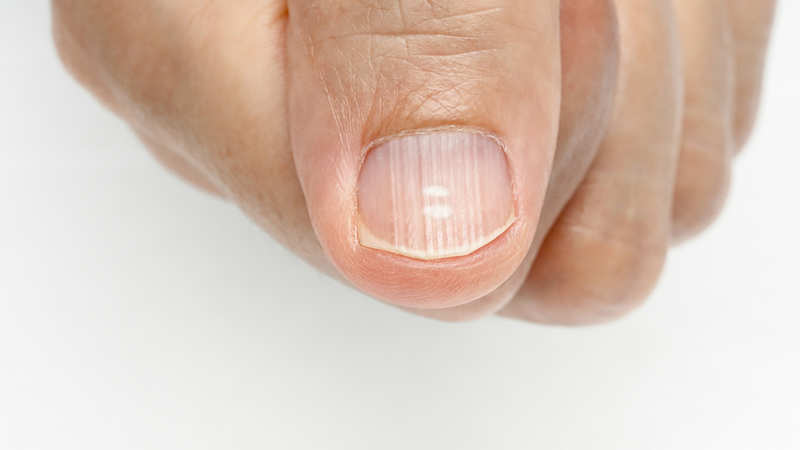 Infections Anemia Psoriasis What Nails Can Reveal About - 