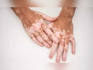 New skin cream for vitiligo treatment causes controversy