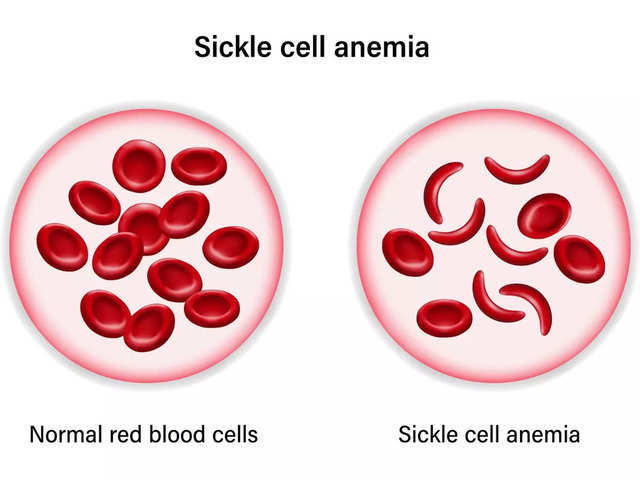 What Is Sickle ​Cell Disease?