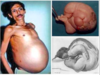 In rare Fetus in fetu case, man from Nagpur was 'pregnant' with his twin for 36 years