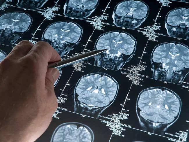Alzheimer's diagnosis revamped with new cancer-like rating system