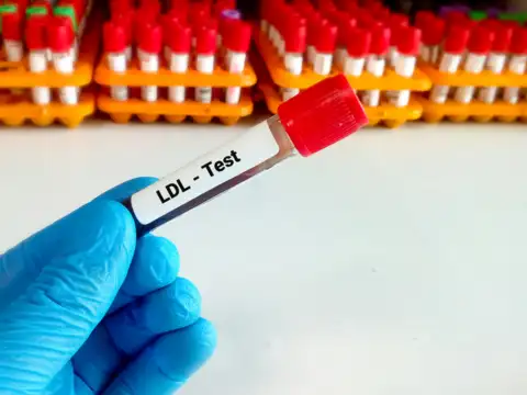 LDL cholesterol (bad cholesterol)