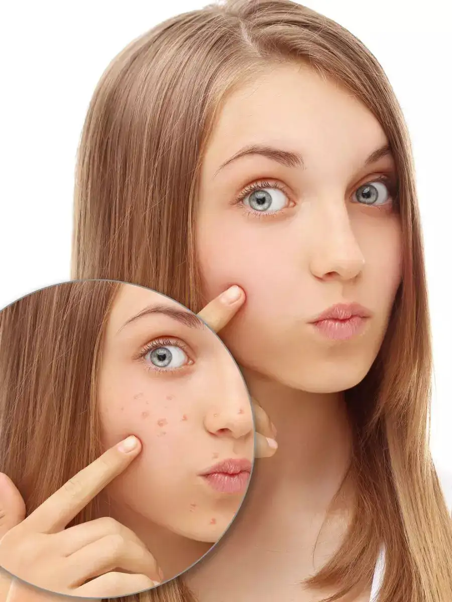 Taming Teenage Acne Tips To Get Rid Of Pimples NewsPoint