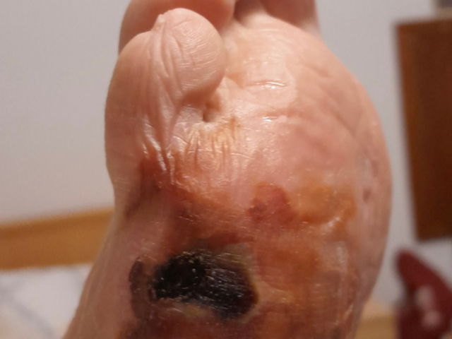 Diabetic foot ulcers