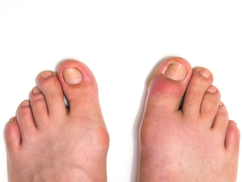 Diabetic Foot Ulcers - Healthtips by TeleMe