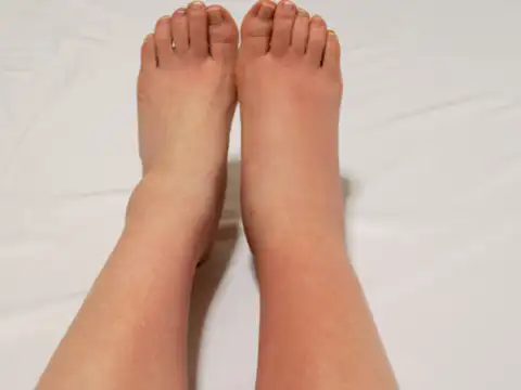 Redness and swelling 