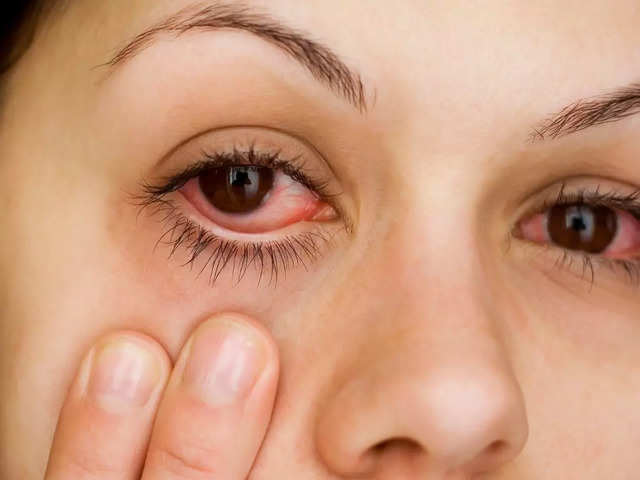 Low vitamin D and severe conjunctivitis
