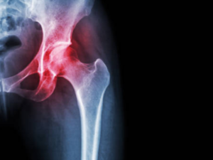 One billion people globally to have osteoarthritis by 2050: Lancet Study
