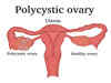 Tired of living with polycystic ovaries? Losing weight can be antidote for PCOS, claim researchers