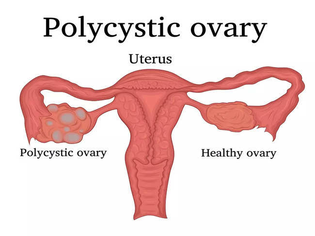 ​Polycystic ovary syndrome (PCOS)​