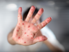 New chickenpox virus variant detected in India: Check symptoms, prevention and more