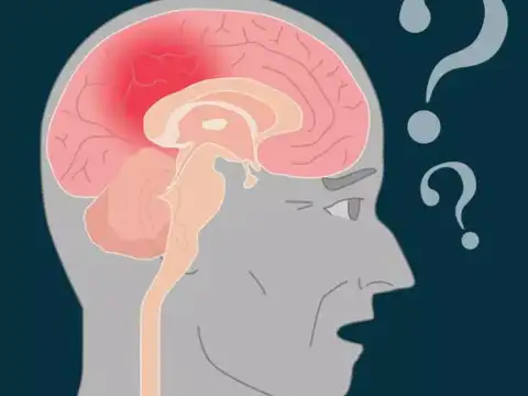 What Causes Vascular Dementia?