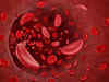 Multi-lateral action needed to curb high prevalence of anaemia in India: Experts