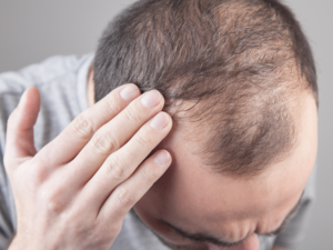 ​​What is Alopecia?​