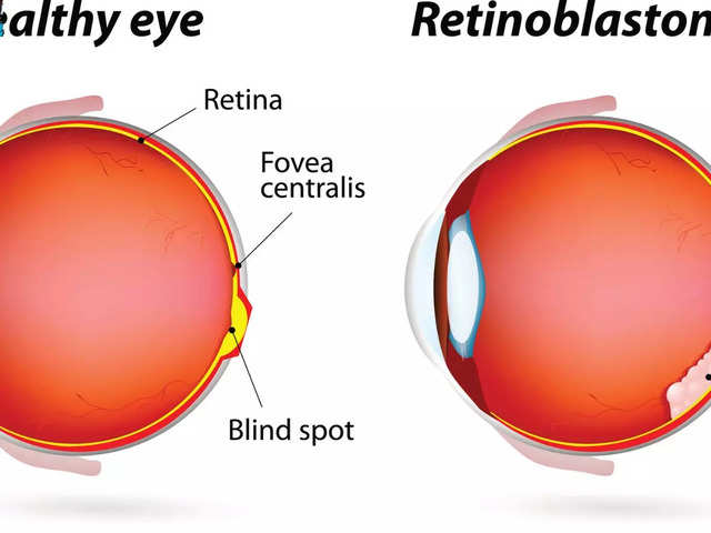 What Are Primary Eye Tumours