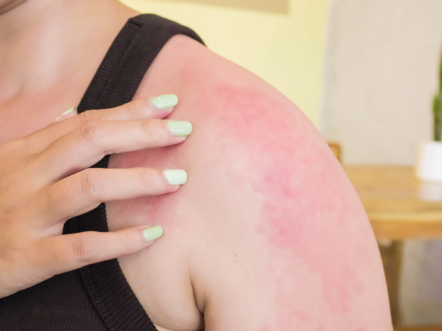 Sunburns and skin irritations