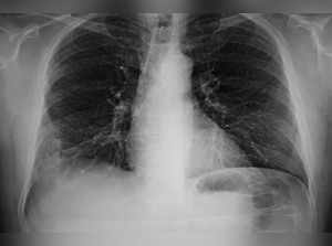What is ‘white lung’ pneumonia? What caused its outbreak in China, here is what we know