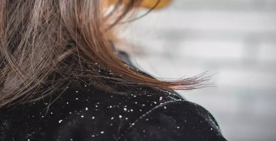 Dandruff season is here. Simple tips to combat this problem - Vimarsana News
