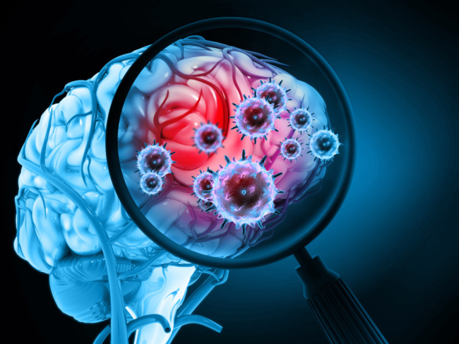 ​Markers of brain injury linked to COVID-19 persist in patients even months after recovery.