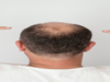 Bald Truth: 7 Health Conditions That Can Cause Hair Loss