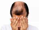 Sun Pharma’s new drug to take on Pfizer, Eli Lilly is having a bad hair day.:Image